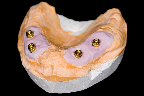 Four implants in clay model